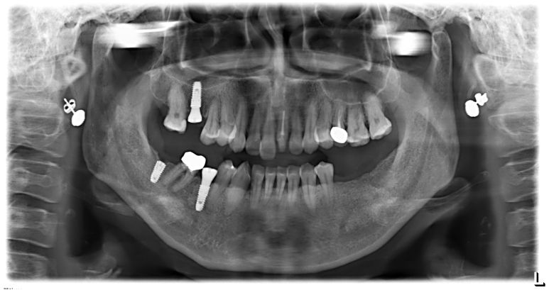 우측 상하악 임플란트 식립 직후 촬영한 파노라마 X-ray