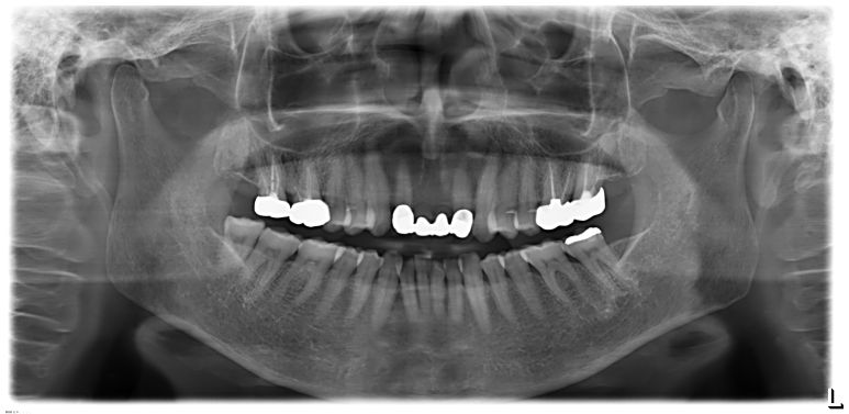 내원 당일 촬영한 파노라마 X-ray 사진