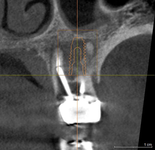 3D CT 기반 모의수술 분석 화면 (발치 즉시 식립 가능 여부 및 잔존골 평가)