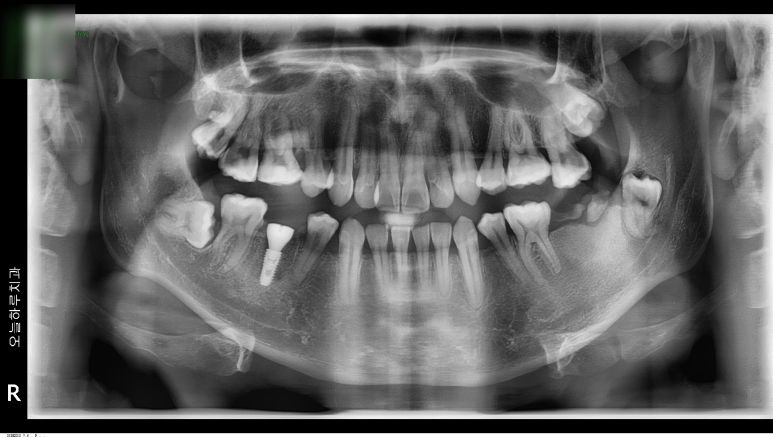 우하악 어금니 발치 후 오스템 BA 픽스처를 식립한 직후의 X-ray 파노라마
