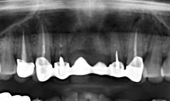 치아 뿌리 끝까지 신경치료 충전재가 완전하지 않음을 보여주는 X-ray 파노라마 사진
