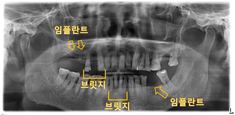 치료 전 X-ray 및 3D-CT 촬영 자료