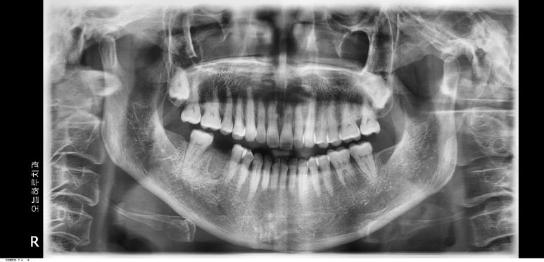 내원 당시 환자분의 파노라마 X-ray 사진