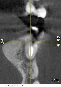 3D CT 단면 영상을 통한 치조골 소실 상태 확인