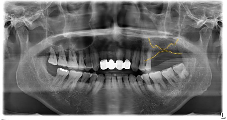 초진 파노라마 X-ray 및 상악동 함기화 관찰 소견