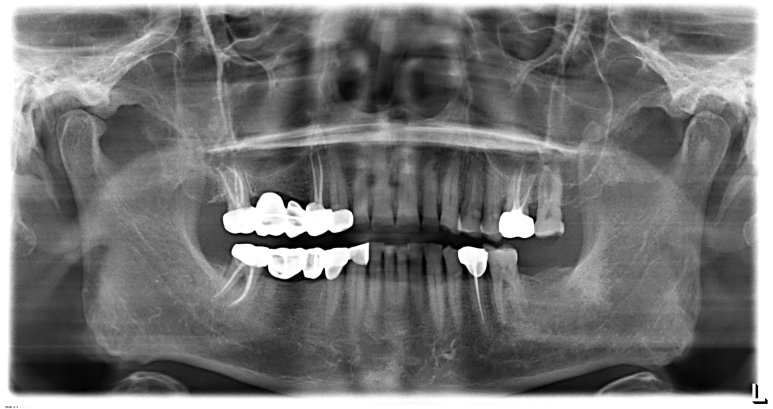 염증으로 손상된 어금니의 X-ray 및 발치 후 자가혈청(PRF) 적용 모습