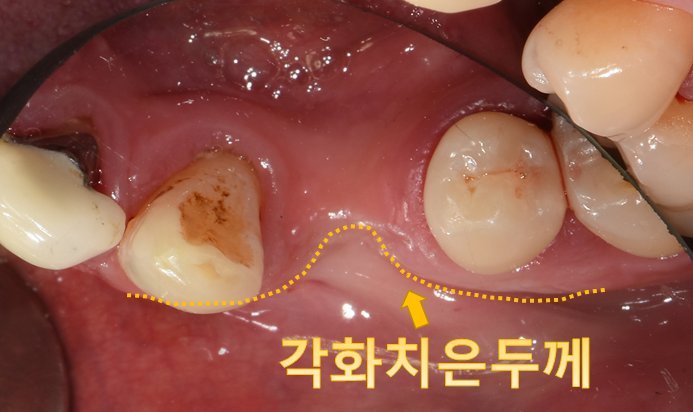 치조골 흡수와 잇몸 상태를 확인하기 위한 구강 내 임상 사진