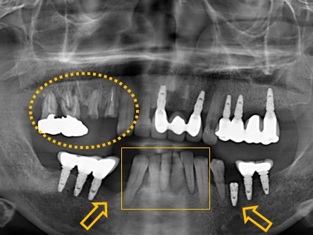 내원 당시 촬영한 파노라마 X-ray 사진입니다. 오른쪽 위 어금니 부위와 아래 앞니 3개의 문제가 확인됩니다.