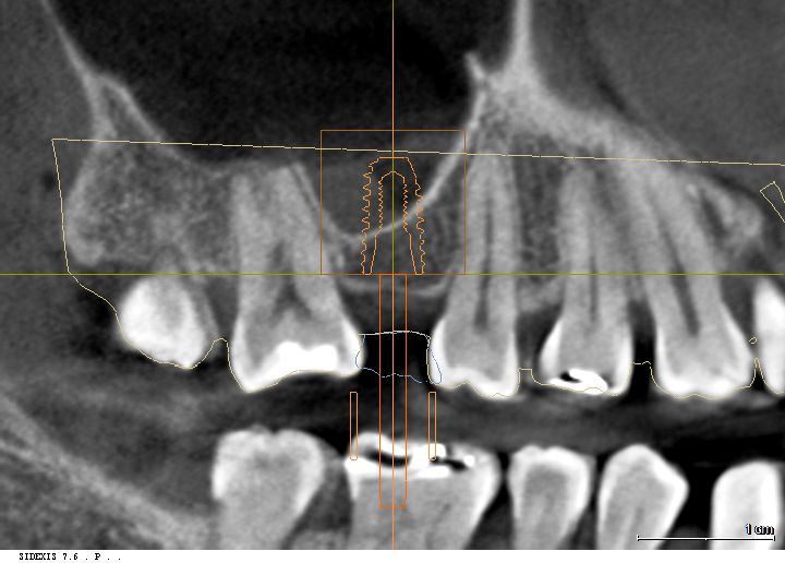 3D CT 정밀 단면 영상: 잇몸뼈 흡수 및 상악동 하방 내려옴 관찰