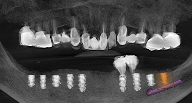 3D CT 단면 영상을 통한 하악 치조골 폭경 및 하치조 신경관 주행 경로 파악