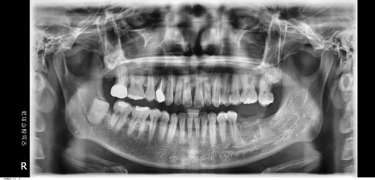 발치와 동시에 리본그라프트(Re:born Graft)를 적용하여 잇몸뼈를 재건한 후의 파노라마 X-ray