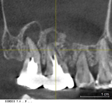 3D CT 정밀 진단 사진 (우측 상악동 염증 및 치근단 병소 확인)