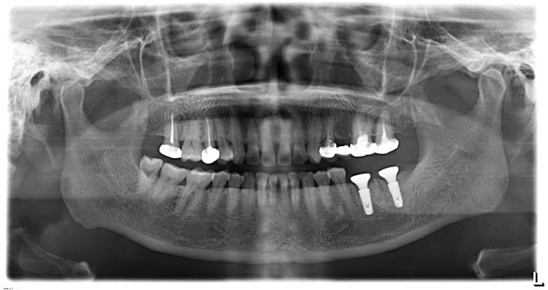 원내 3D 프린터로 출력한 맞춤 수술 가이드 및 정밀 식립 계획