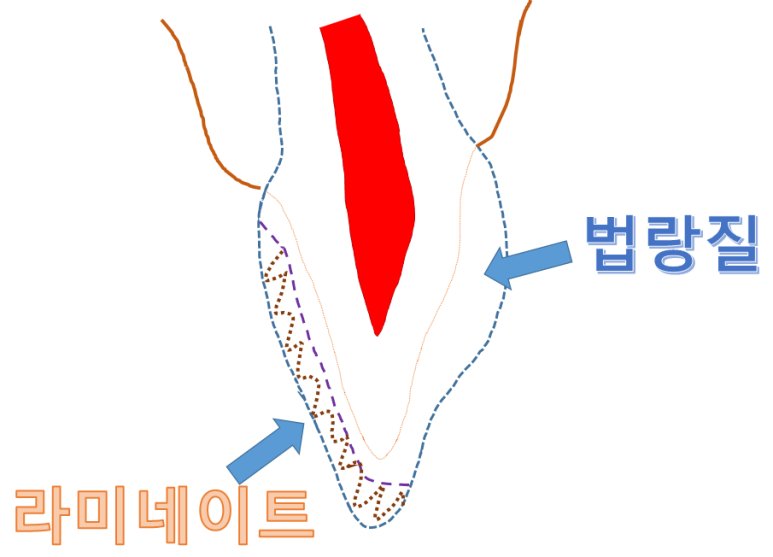 법랑질(30MPa)과 상아질(20MPa)의 에칭 후 접착 결합력 비교