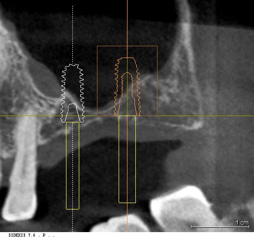3D CT 상에서 확인한 남은 치조골 높이 및 모의시뮬레이션