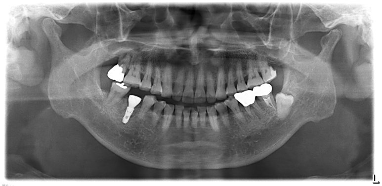 발치 당일 임플란트 식립 및 뼈이식 후 X-ray 사진