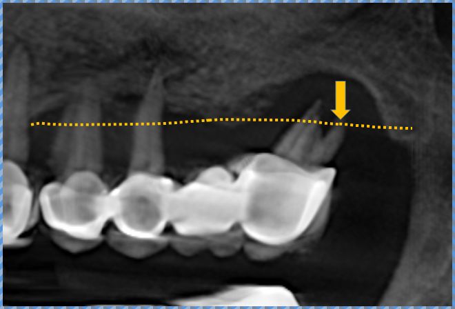 3D CT 진단을 바탕으로 한 치조골 뼈이식 및 재건 계획 (노란 점선 영역)