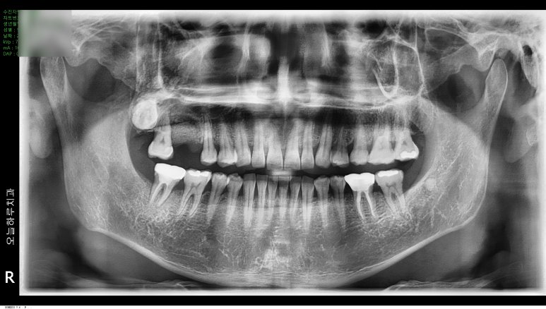 뼈이식 수술 직후 파노라마 X-ray 사진