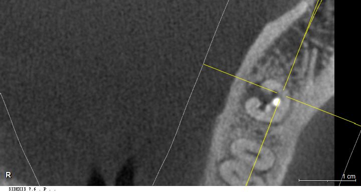 재발 당시 3D CT 단면 영상 — 치근 설측 부위 염증 병소 확인