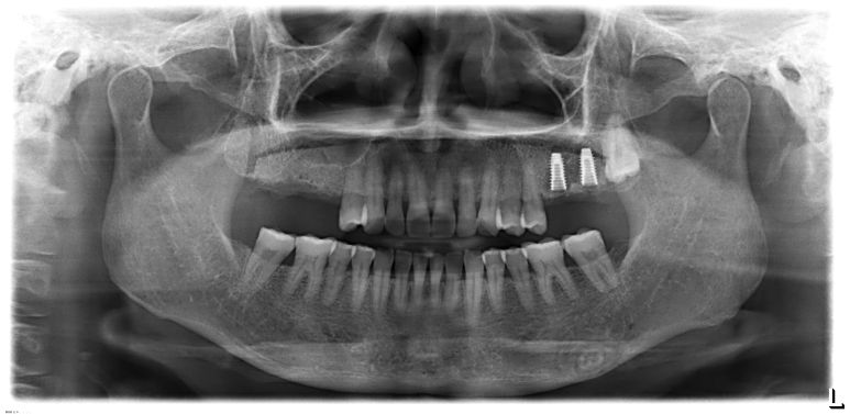 네비게이션 수술 가이드를 활용해 디오 UV 임플란트를 정확히 식립한 후 X-ray
