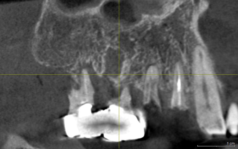 3D-CT 촬영을 통해 임플란트 식립 부위의 치조골 상태를 정밀하게 분석하는 모습입니다.