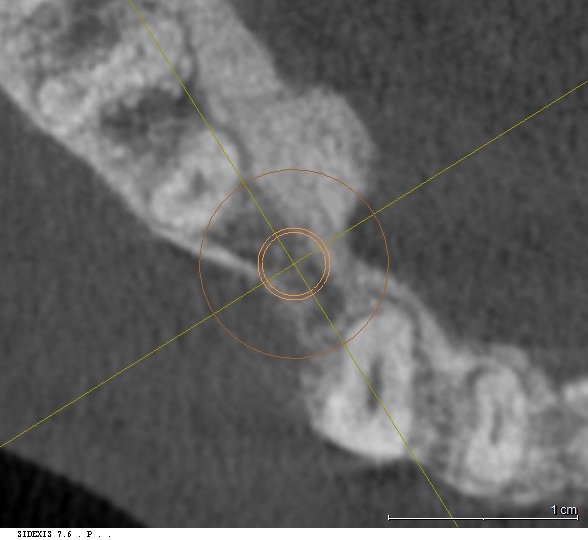 3D-CT 단면 분석을 통해 확인한 좁아진 치조골 폭