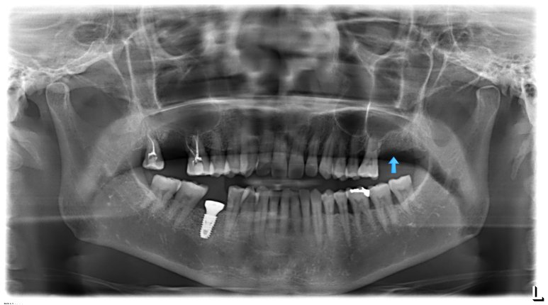 아래 어금니 임플란트 식립 직후 X-ray