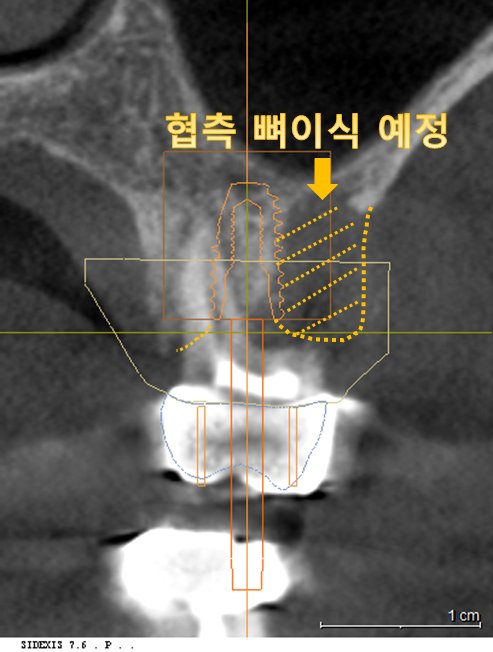 네비게이션 임플란트 시스템을 활용한 3D 식립 계획
