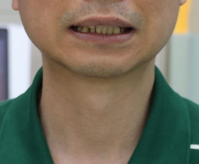 지르코니아 브릿지 치료 계획 수립 과정