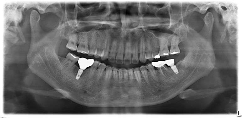 식립 2개월 후 지르코니아 최종 보철물 수복을 마친 파노라마 X-ray