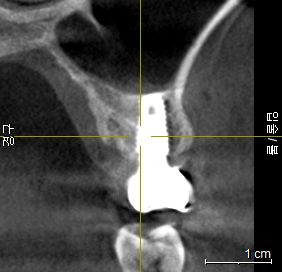 치료 후 3D CT 재촬영: 상악동 하부 신생 치조골 형성 단면