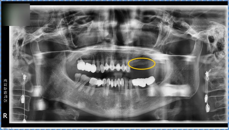 상악 좌측 치조골 뼈이식 직후 촬영한 X-ray 사진: 이식재가 균일하게 채워진 모습