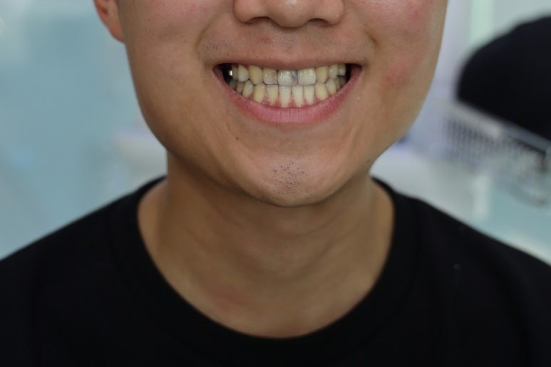 치료 전 앞니의 측면 모습