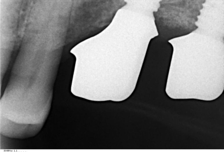 수술 6개월 후 잇몸 안착 및 맞춤지대주(Custom Abutment) 연결