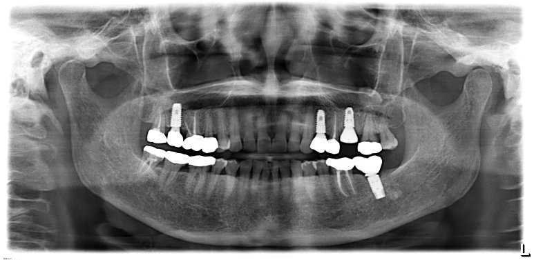 발치와 동시에 임플란트 식립 및 뼈이식이 완료된 직후 파노라마 X-ray