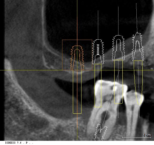 우측 상악동 부위 잔존 치조골 높이 측정 3D CT 영상