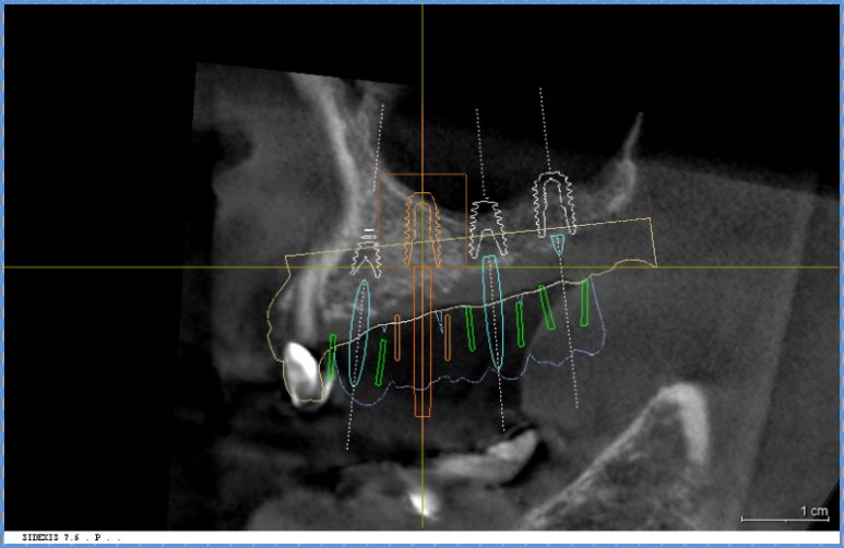 뼈이식 4개월 후 골 형성이 안정적으로 이루어진 상태를 확인한 X-ray 사진