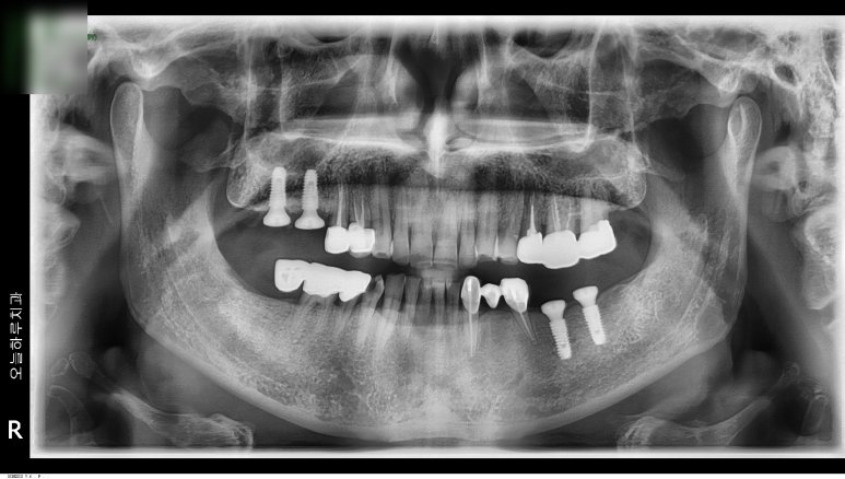 왼쪽 위 어금니 임플란트 식립 직후의 X-ray 사진