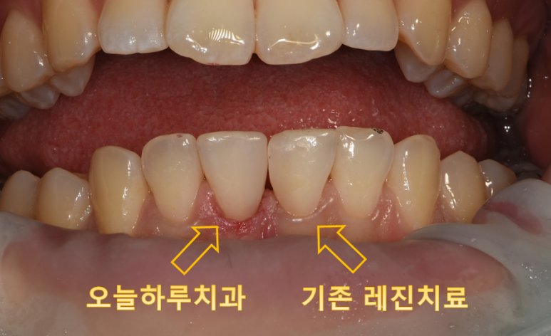 레진 치료 직후의 자연스러운 결과
