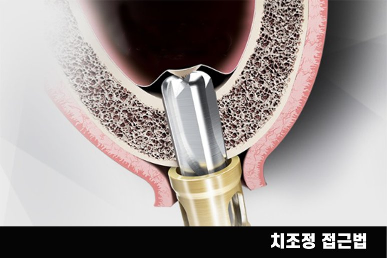 네비게이션 임플란트 식립 계획 시뮬레이션