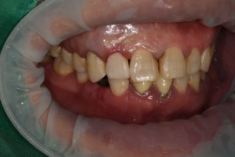 치료 후