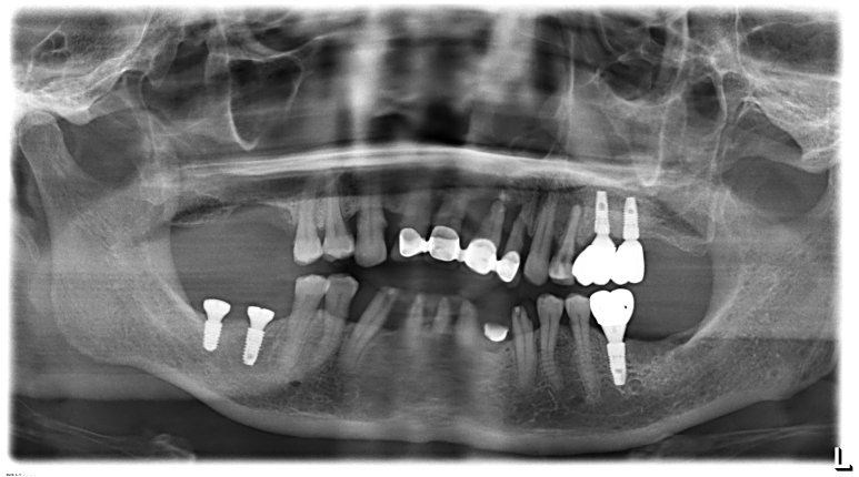 우측 상하악 어금니 치료 계획을 위한 3D-CT 입체 진단 영상