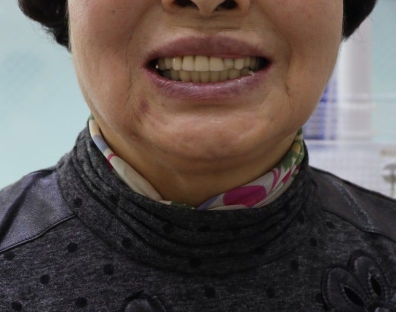 수술 다음 날 하악에 고정성 임시치아가 안정적으로 장착된 구강 내 모습