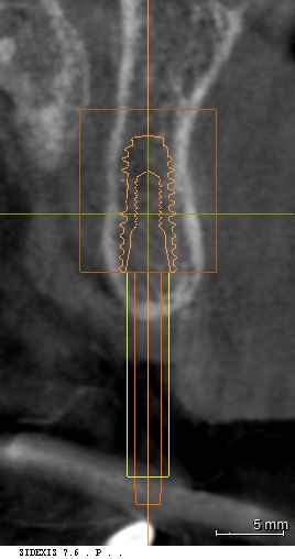 3D CT 단면 분석을 통해 비구개관과의 거리 및 뼈 두께 측정