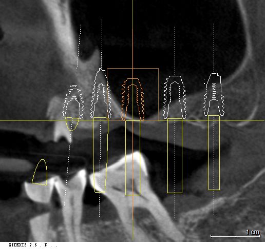좌측 상악동 및 잔존 치조골 단면 분석 3D CT 이미지