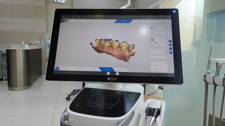 프라임스캔 구강스캐너를 활용한 3D 디지털 인상 채득 및 세렉 프로그램 보철 디자인