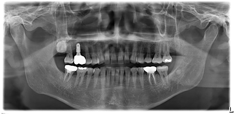 임플란트 식립 후 파노라마 X-ray 사진