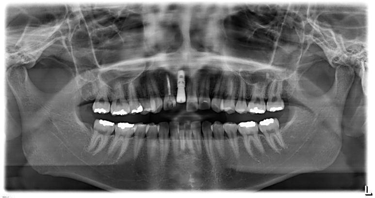 계획된 각도와 깊이로 정확하게 식립된 임플란트 X-ray 소견