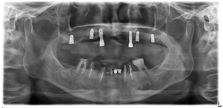 상악 6개 네비게이션 임플란트 식립 및 상악동거상술 완료 후 파노라마 X-ray