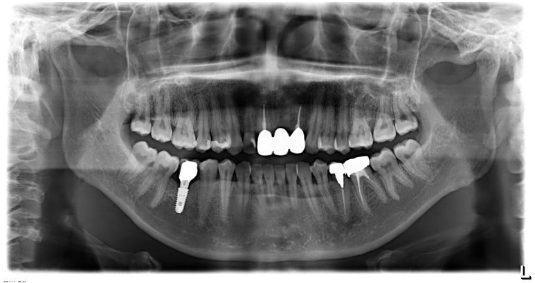 치료 완료 후 촬영한 파노라마 X-ray 사진으로 지르코니아 브릿지 세팅을 확인합니다.